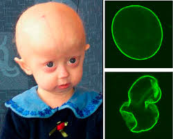 Primer tratamiento que prolonga la vida de niños con progeria