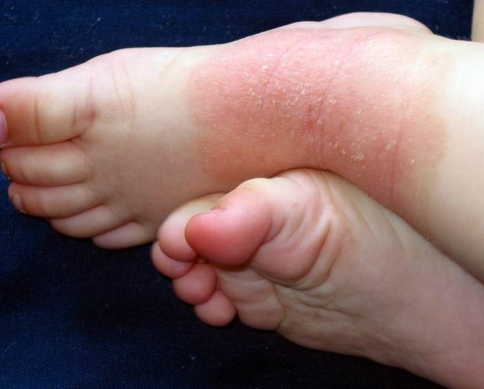 Nuevos tratamientos para controlar la dermatitis atópica