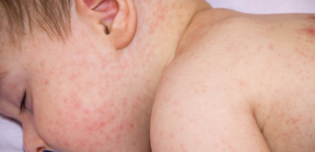 La dermatitis atópica es una de las enfermedades inflamatorias de la piel más frecuentes