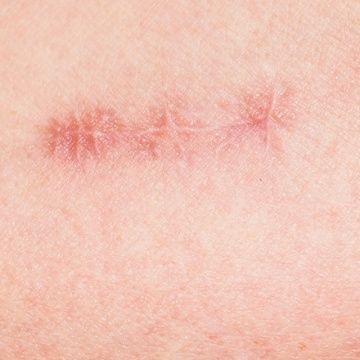 Heridas complejas: ¿cómo cicatrizan?