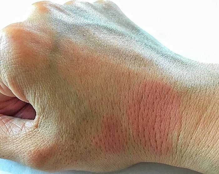 Nuevo test para predecir el riesgo de recaída en los enfermos de lupus