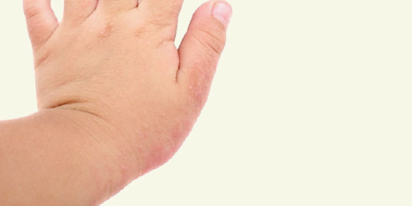 Ya está disponible en Argentina el primer medicamento específico para la dermatitis atópica severa en adultos