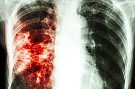 La desigualdad en los casos de tuberculosis en la Ciudad Autónoma de Buenos Aires