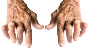 Avances en el tratamiento de la artritis reumatoidea