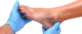 Úlceras venosas: cuidados para el verano