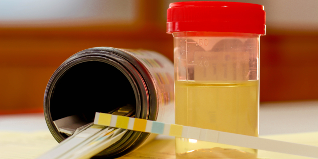 Una prueba de orina podría revolucionar el diagnóstico de cáncer de próstata