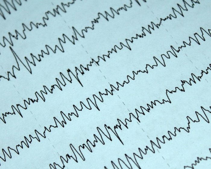 Cirugía de epilepsia: un método digital ayuda a identificar la zona donde se originan las crisis en cada paciente