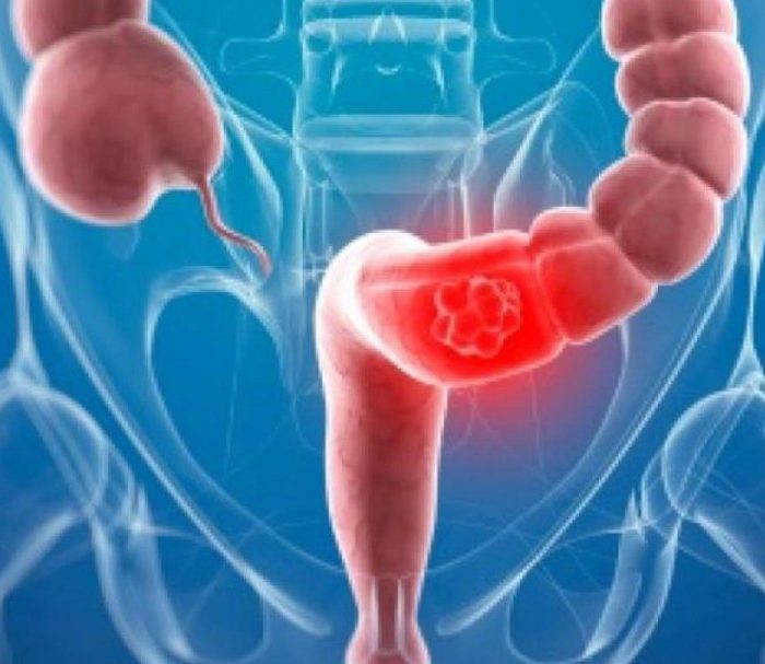 Cáncer de colon: estudios preventivos pueden salvar a la mitad de los pacientes Cáncer de colon: estudios preventivos pueden salvar a la mitad de los pacientes