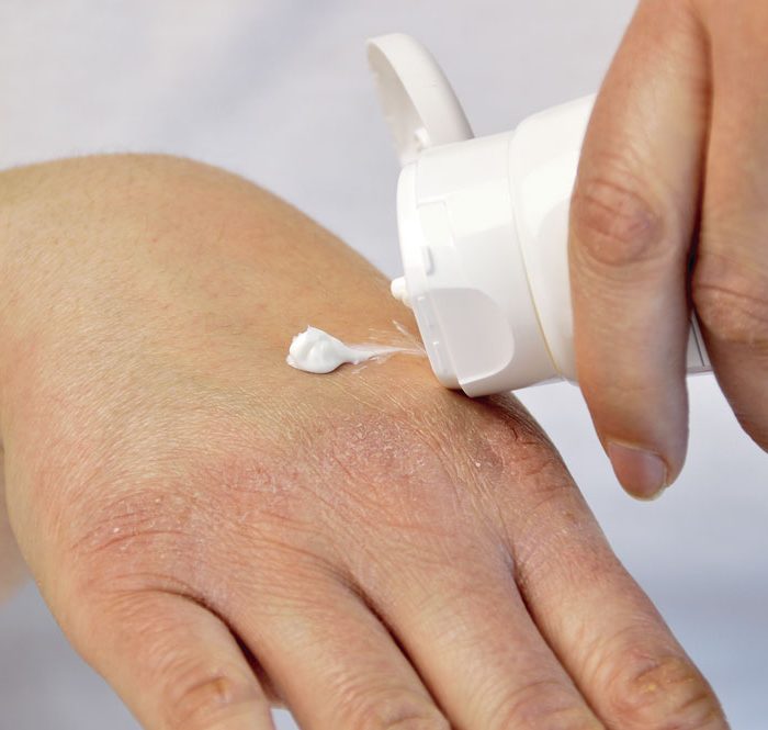 Dermatitis atópica: “Es pertinente que los padres expliquen a los docentes en qué consiste y cómo se manifiesta en su hijo”