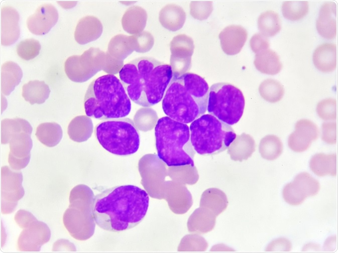 Leucemia Mieloide Aguda: la importancia de no demorar su diagnóstico ni su tratamiento