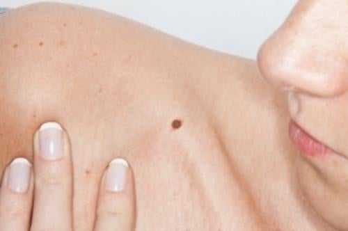 Melanoma ¿cómo es el cáncer de piel más agresivo?