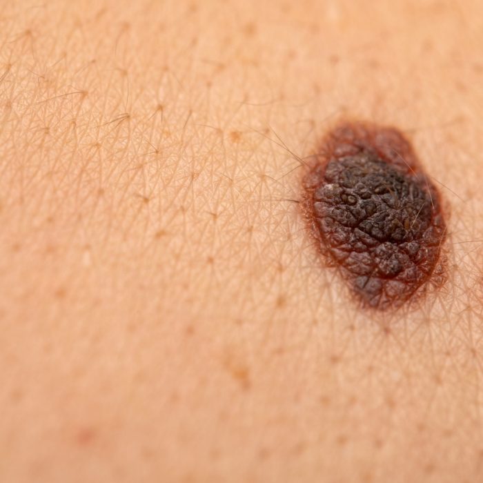 ¿Cómo evitar la aparición de un melanoma? ¿Cómo evitar la aparición de un melanoma?