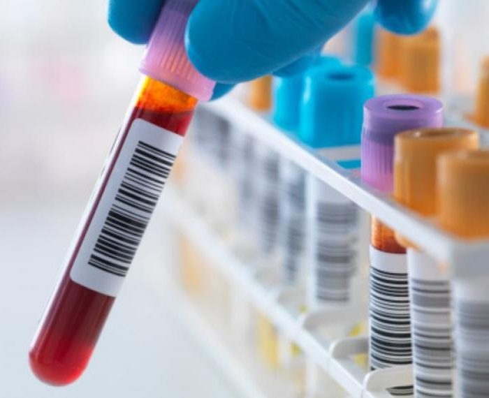 Un análisis de sangre podría detectar el cáncer en las etapas tempranas Un análisis de sangre podría detectar el cáncer en las etapas tempranas
