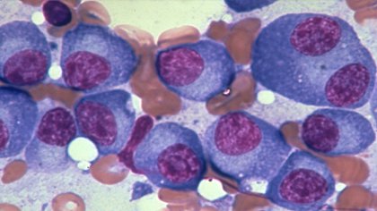 Investigadores españoles descifran el epigenoma del mieloma múltiple, un agresivo cáncer de la sangre