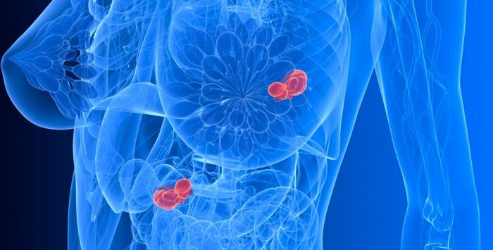 Una investigación española detecta una proteína para evitar la metástasis del cáncer de mama