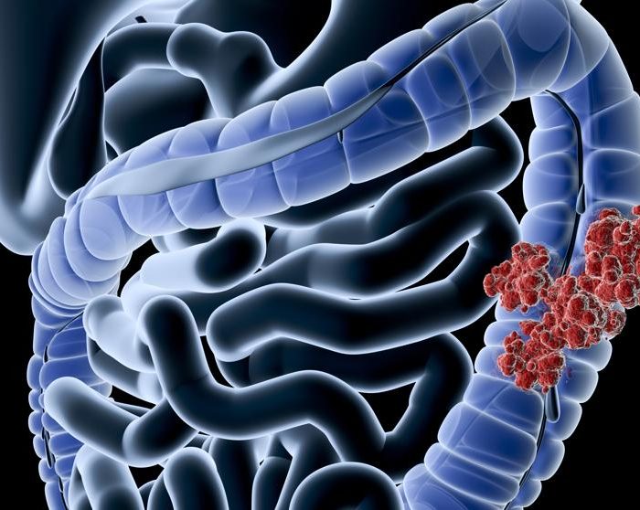 Disminuyeron consultas y cirugías por cáncer colorrectal con la pandemia