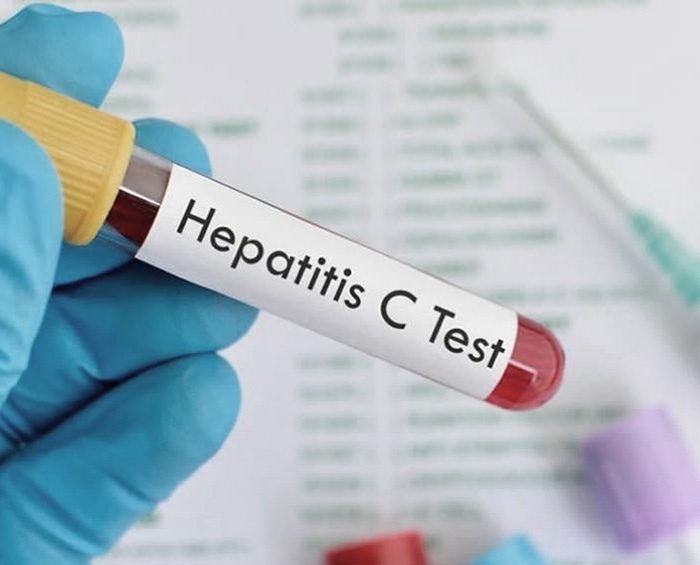 Virus de la hepatitis C, un enemigo silencioso que es posible curar