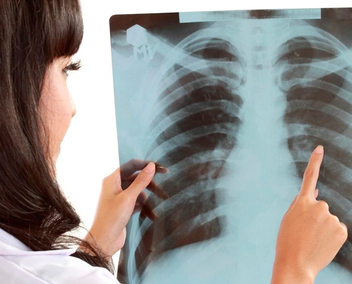 Aprobaron inmunoterapias simultáneas que prolongan la sobrevida en pacientes con cáncer de pulmón
