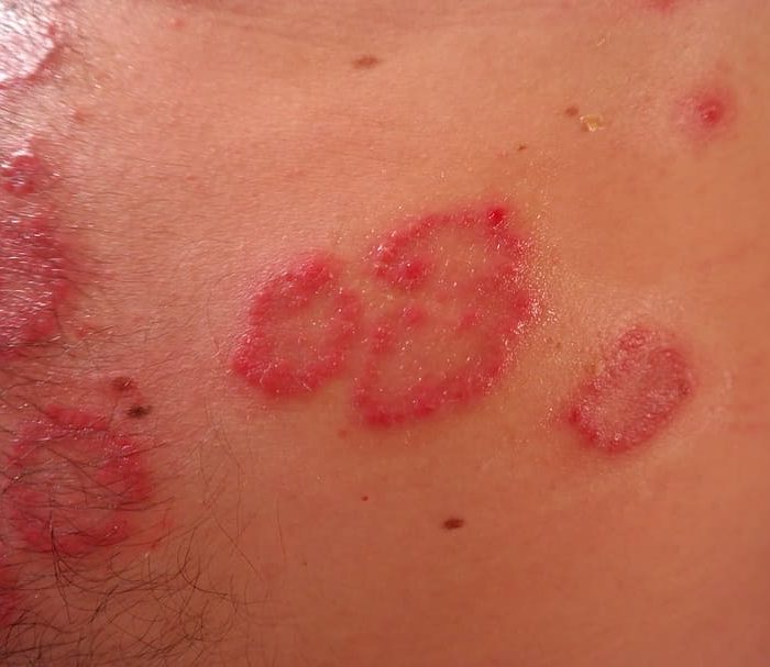 La inhibición de una proteína alivia los síntomas de la psoriasis