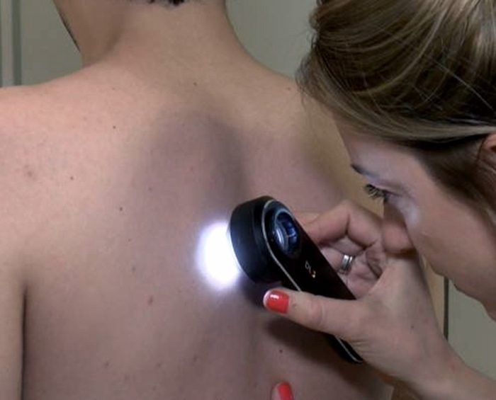 Advierten que disminuyeron los controles para prevenir el cáncer de piel por la pandemia