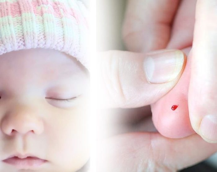 FENILCETONURIA: una de las patologías genéticas del programa de la pesquisa neonatal