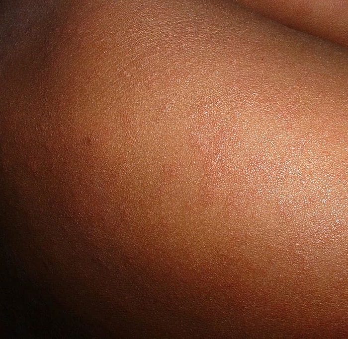 Lupus: avances en el tratamiento para niños