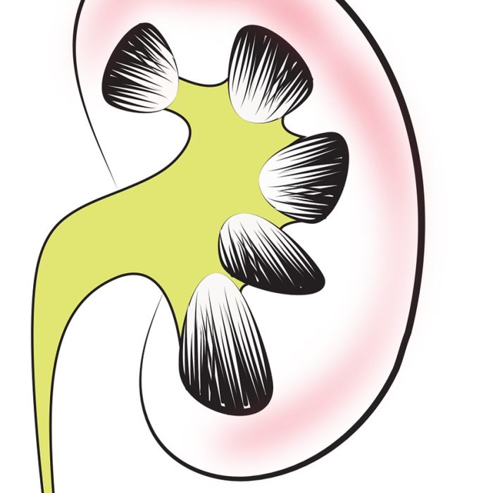 Sólo una de cada 10 personas con enfermedad renal crónica sabe su condición Sólo una de cada 10 personas con enfermedad renal crónica sabe su condición
