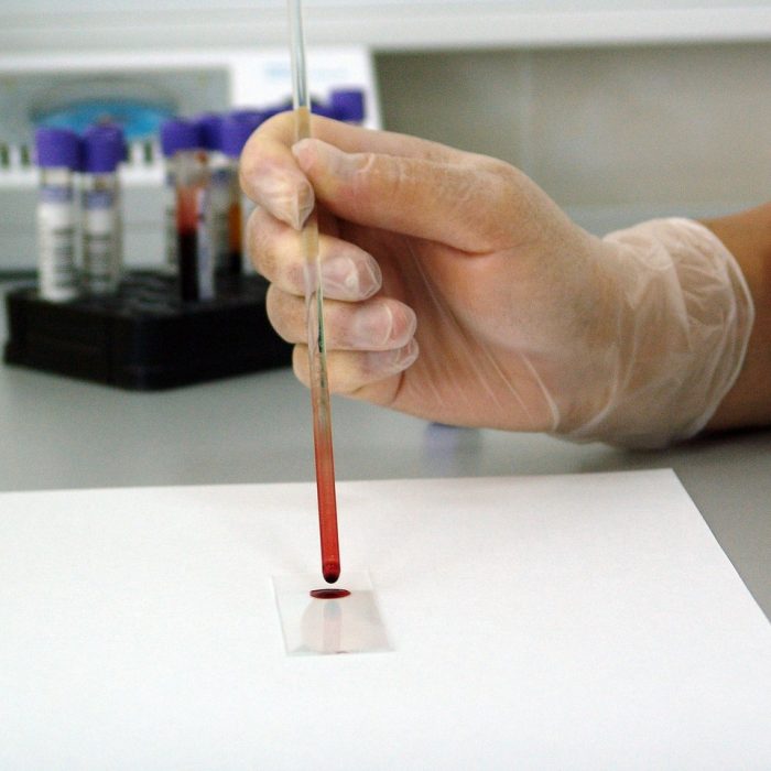 Un test de sangre personaliza y mejora la terapia para la leucemia más común