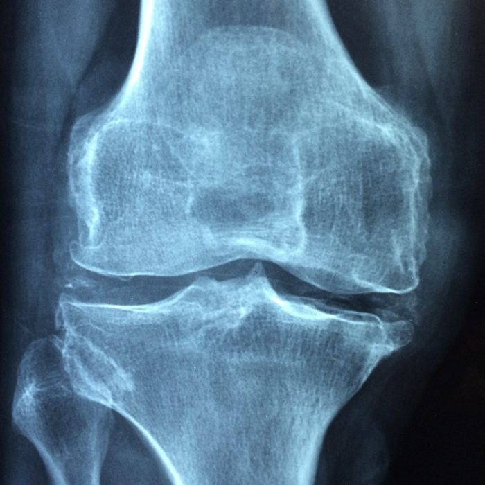 Un estudio en busca de biomarcadores genéticos en la osteoporosis