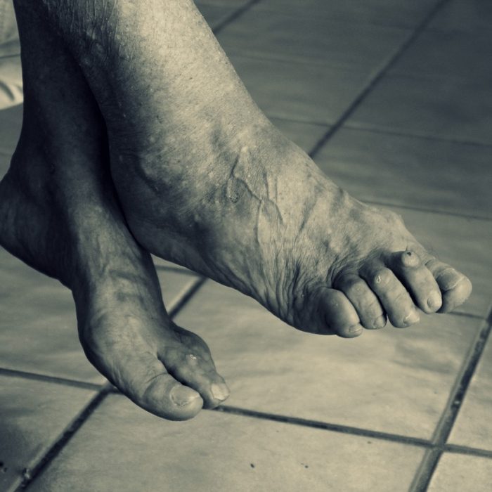 Un análisis de proteínas en la sangre puede predecir la demencia con más de diez años de anticipación