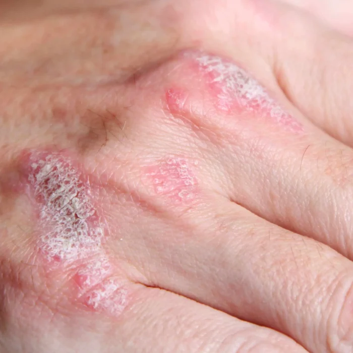 “Mi Psoriasis”, una plataforma para acompañar a pacientes con esta enfermedad crónica “Mi Psoriasis”, una plataforma para acompañar a pacientes con esta enfermedad crónica