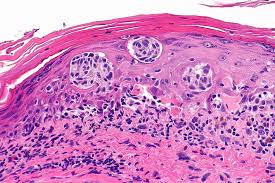 Detección temprana del melanoma Detección temprana del melanoma