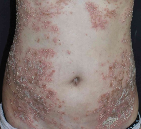 Psoriasis pustulosa: nuevo tratamiento en Argentina