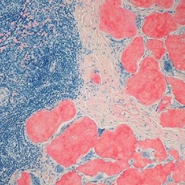 Amiloidosis Hereditaria por Transtiretina: afecta a unas 50 mil personas en el mundo