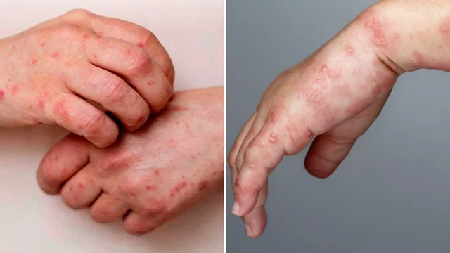 Viruela símica y herpes zóster: ¿cuáles son las diferencias? Viruela símica y herpes zóster: ¿cuáles son las diferencias?