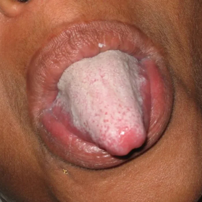 Qué tiene que ver la lengua blanca con un eventual contagio de sífilis