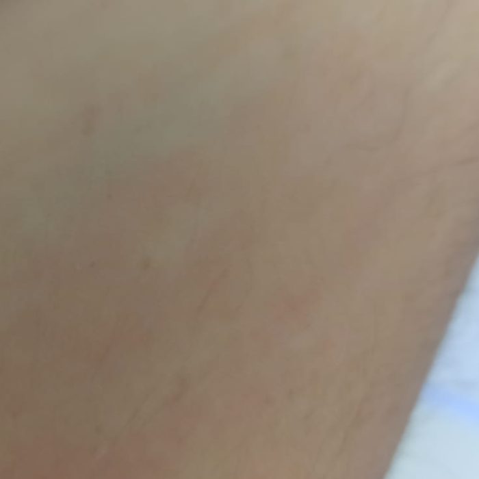 Urticaria crónica: un impacto profundo en la calidad de vida