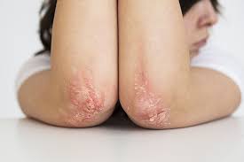 El 42% de los pacientes con psoriasis postergó o suspendió la consulta médica por motivos económicos