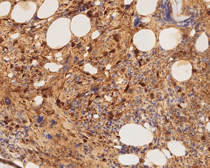 Revelan un nuevo blanco terapéutico para el tratamiento de cánceres de sangre