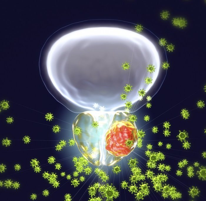 Cáncer de próstata: una promesa para un diagnóstico y tratamiento más preciso