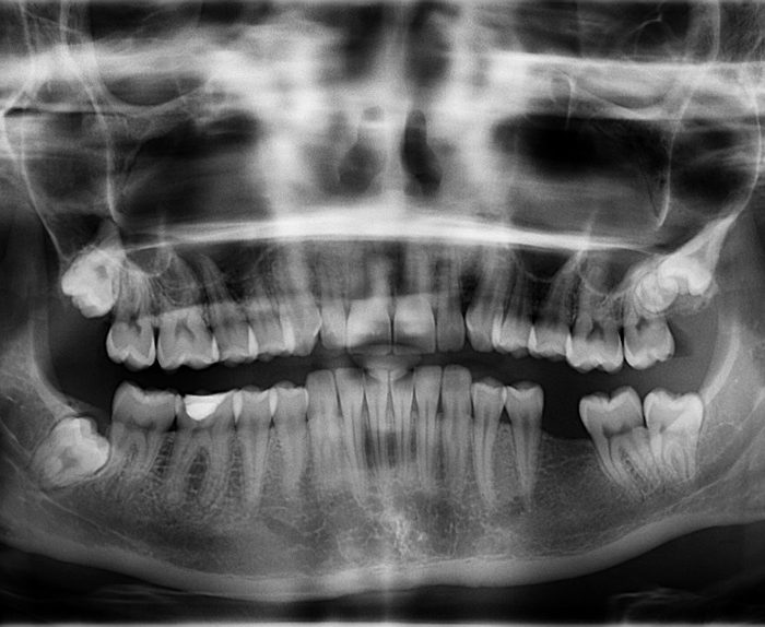 Innovación: así es el gel quita caries