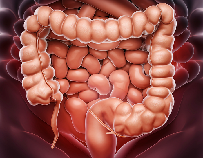 Cáncer de colon: 9 de cada 10 casos pueden evitarse realizando los controles
