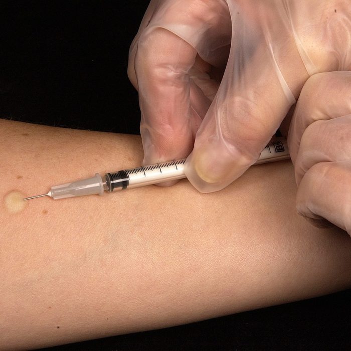 Mientras la tuberculosis aumenta en las Américas, también avanzan las innovaciones