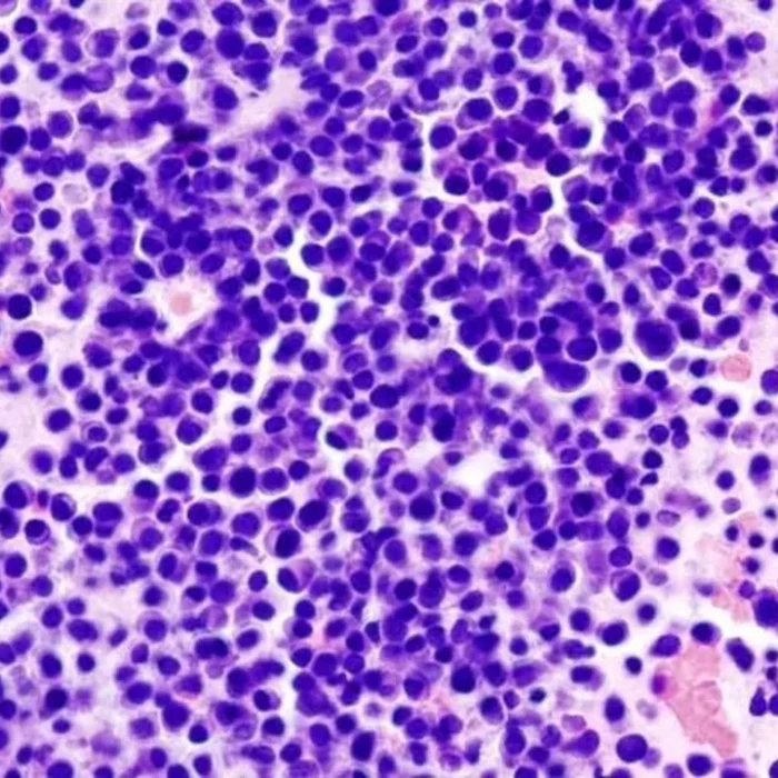 Mieloma múltiple: terapia reduce el riesgo de progresión o muerte en un 58%