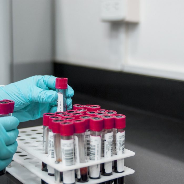 El test de sangre que avisa si reaparece el melanoma detectando fragmento de ADN