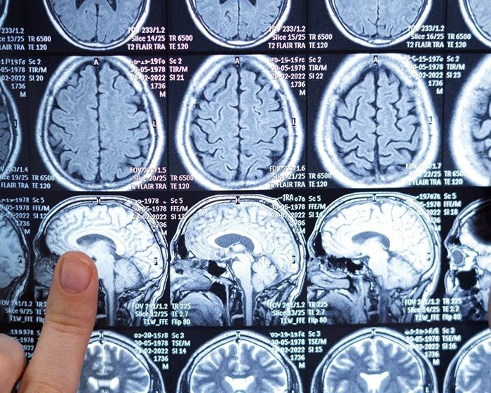 Identifican proteínas novedosas implicadas en la neurodegeneración de las formas más discapacitantes de la esclerosis múltiple