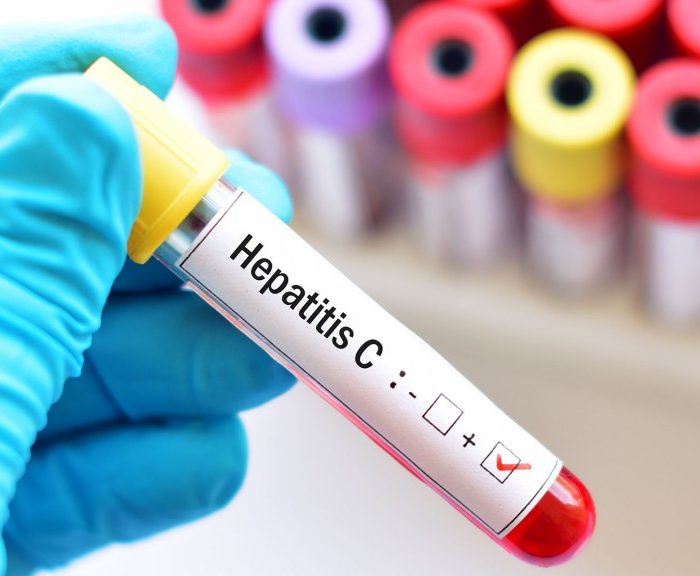 8 de cada 10 pacientes con hepatitis C no saben que la tienen