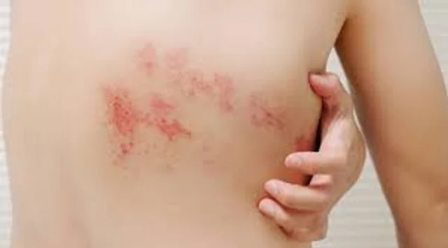 El herpes zóster afecta cada vez a más adultos mayores y genera preocupación médica por sus secuelas El herpes zóster afecta cada vez a más adultos mayores y genera preocupación médica por sus secuelas