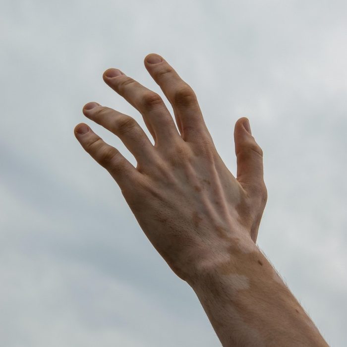 El vitiligo puede afectar a entre el 0,5% y el 2% de la población