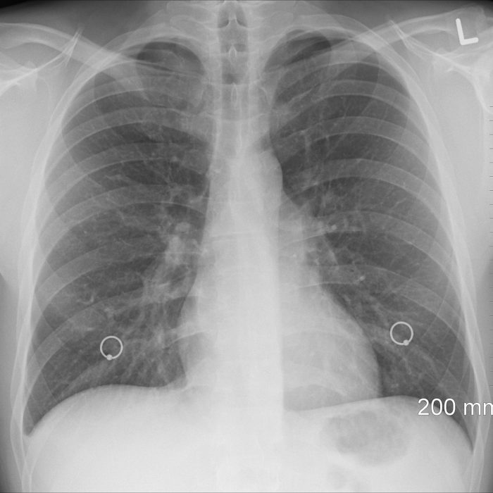Fibrosis quística, la enfermedad genética más frecuente